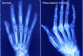  Rheumatoide arthritis